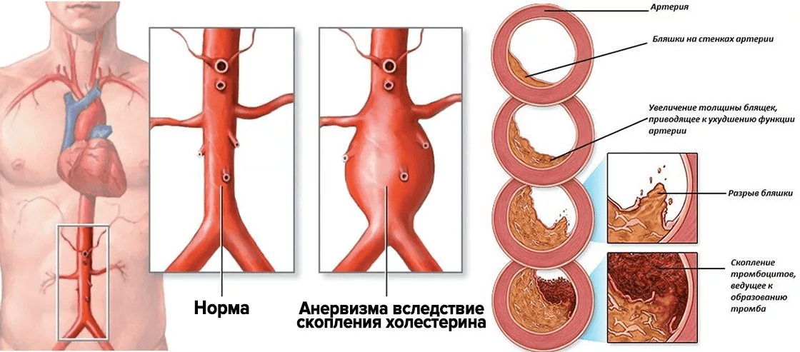 Склероз брюшной аорты. Атеросклеротическая аневризма аорты. Кальциноз атеросклероз аорты. Атеросклероз брюшной аорты.